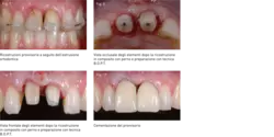 Geometria del dente appropriata